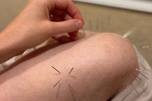 Acupuncture and Dry Needling — Stuart and Port St. Lucie FL Acupuncture and dry needling treatment at Treasure Coast Spine and Sport Stuart FL