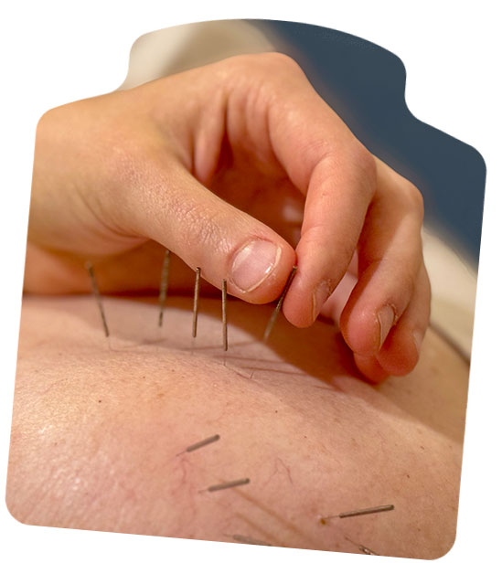 Acupuncture